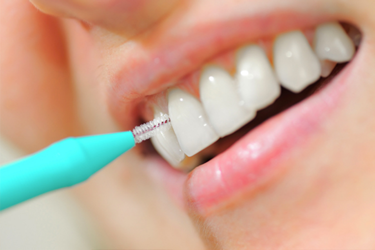 Dentista a Treviglio  L'efficacia dello scovolino – Studio